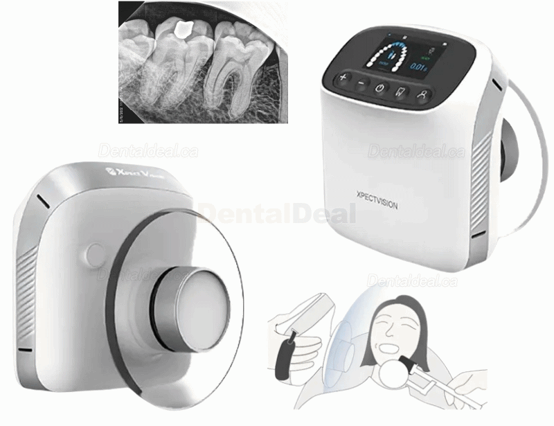 XVbeam2000 Dental Portable Dental X-Ray Machine Handheld High Frequency XRay Unit